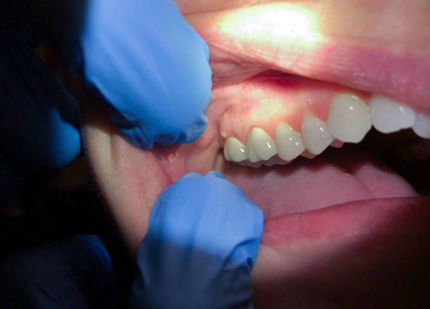 Best Emergency Treatment for Dental Infections or Abscesses in Van Buren, MO